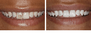 Invisible Braces (Invisalign), Sarnia, Ontario