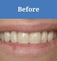 before image of before and after dental veneers picture in sarnia